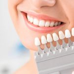 ¿Cuál es el mejor implante dental?